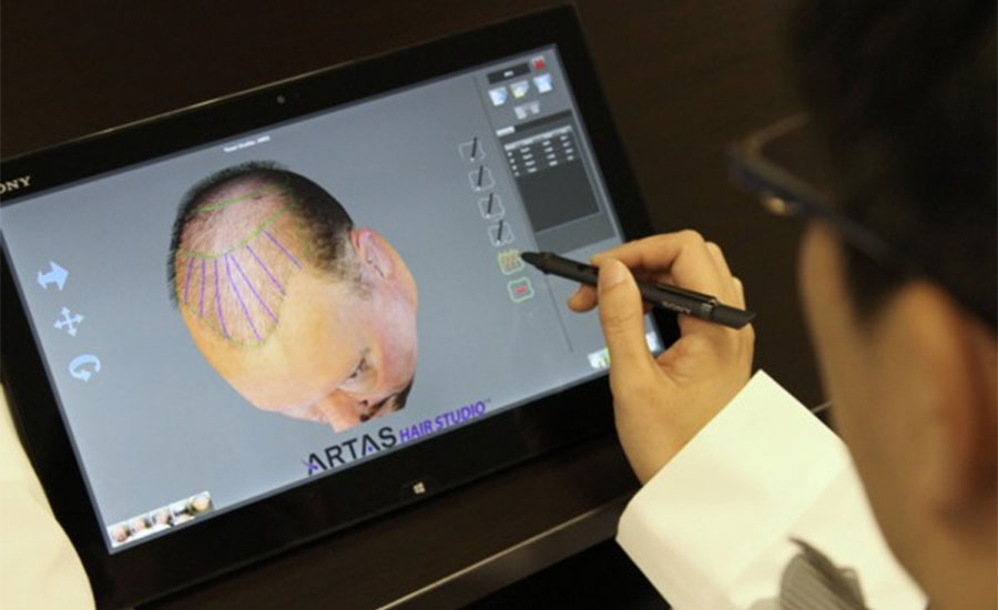 Das 3-D Animationsprogramm zur Haartransplantation mit Hilfe des ARTAS Roboters